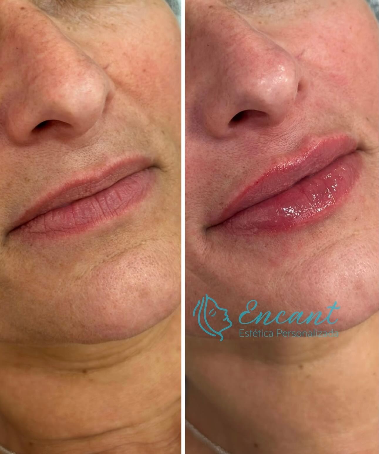 Preenchimento labial