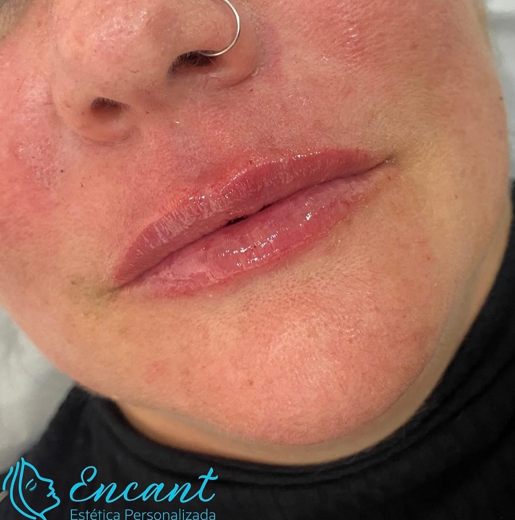 Preenchimento labial