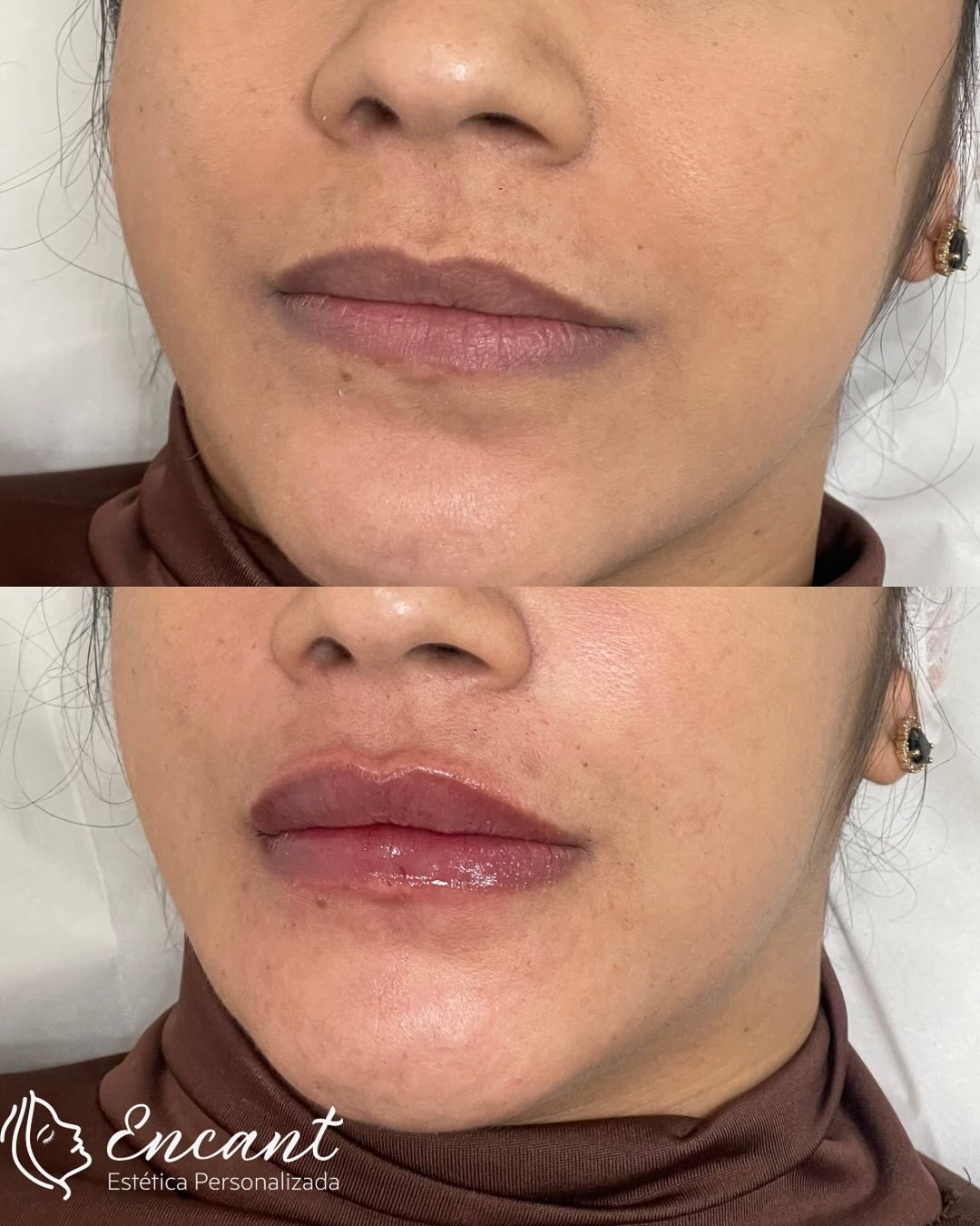 Preenchimento labial antes e depois